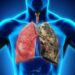 Tabaquismo y cáncer de pulmón