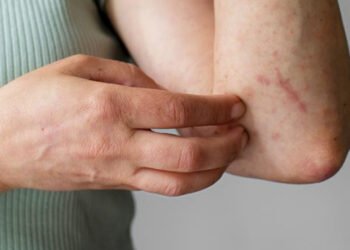 Concentran cinco municipios 59.4% de casos de dengue en Puebla: Salud