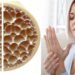 Osteoporosis afecta 10 millones de personas en México